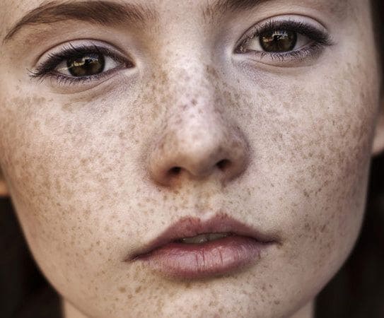 Пигментация лица – как избавиться и чем она опасна
